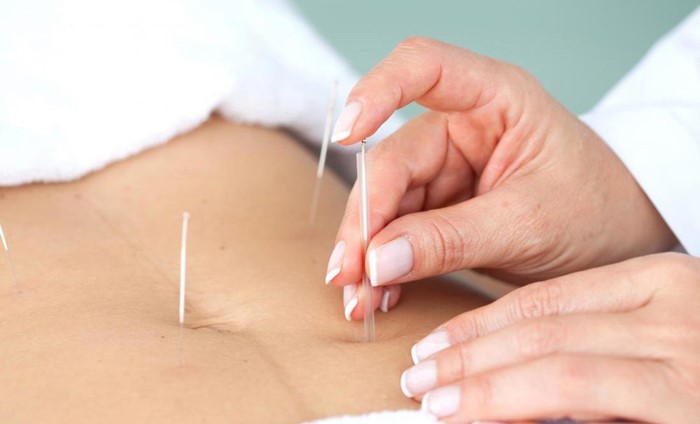 طب سوزنی | Acupuncture