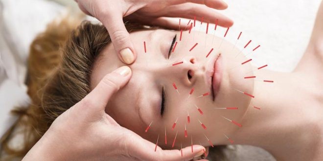 طب سوزنی | Acupuncture