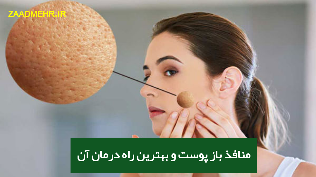 منافذ باز پوست و درمان آن