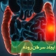 سرطان روده