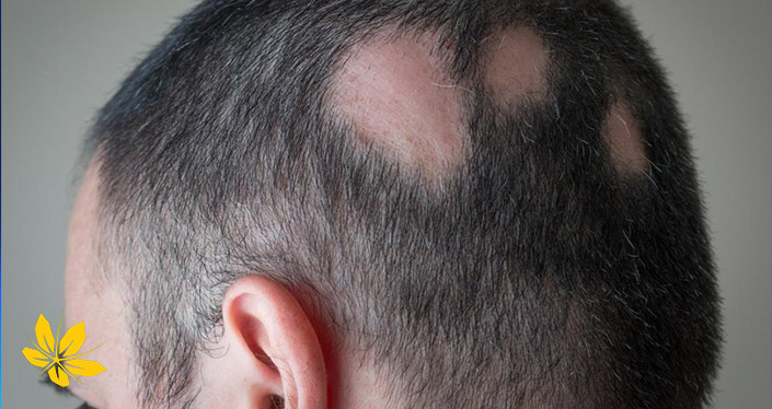 آلوپسی و عوامل آن | Alopecia and its factors