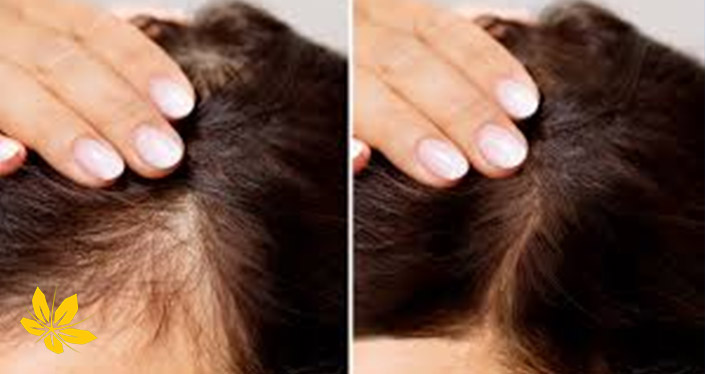درمان آلوپسی با طب سنتی | Alopecia treatment