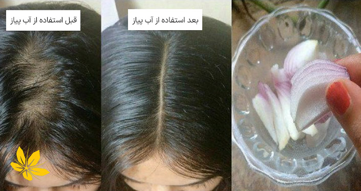 قبل و بعد از استفاده از آب پیاز برای درمان آلوپسی | Before and after using onion juice for alopecia