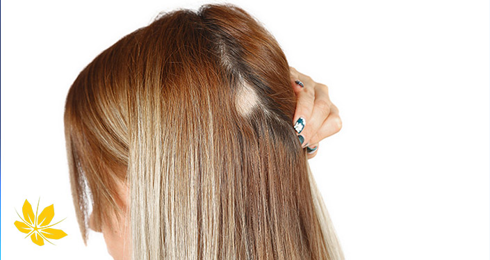 آلوپسی چیست؟ | What is alopecia؟