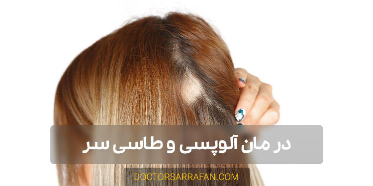 درمان آلوپسی و طاسی سر - alopecia and bald head treatment