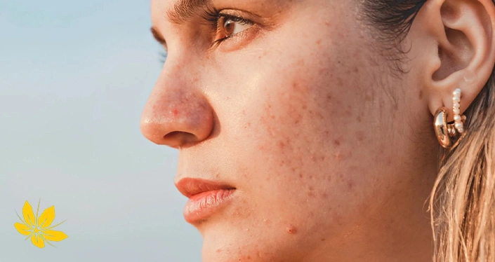 facial acne - جوش صورت