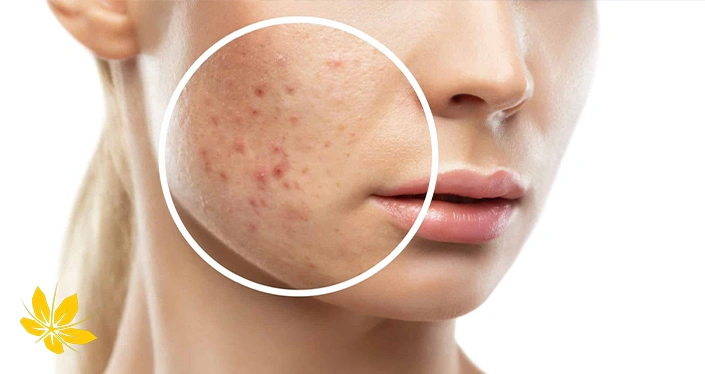 women's acne - جوش در بانوان