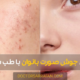 women's facial acne - درمان جوش صورت بانوان با طب سنتی