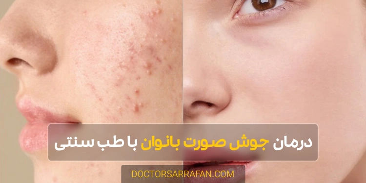women's facial acne - درمان جوش صورت بانوان با طب سنتی