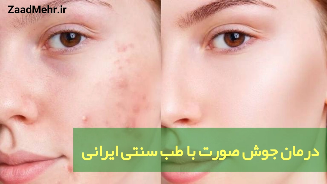 درمان جوش صورت با طب سنتی