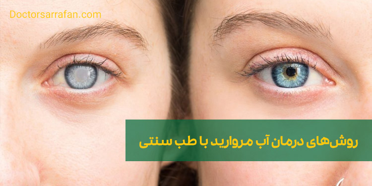 درمان آب مروارید با طب سنتی | Cataract treatment with traditional medicine