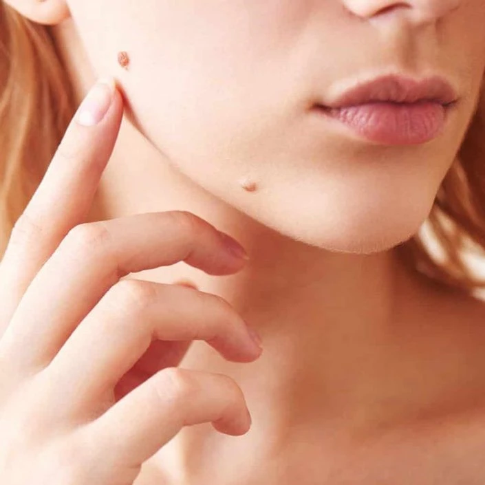 درمان خال با طب سنتی