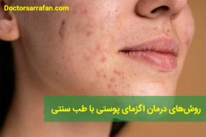 درمان بیماری اگزما با طب سنتی