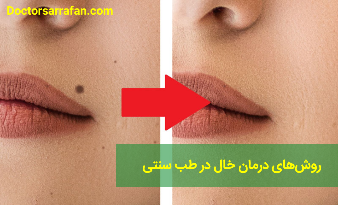 بررسی روش‌های درمان خال در طب سنت