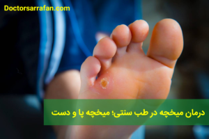 درمان میخچه در طب سنتی؛ میخچه پا و دست