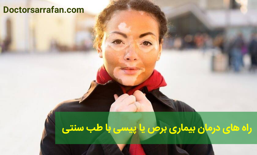راه های درمان بیماری برص یا پیسی با طب سنتی