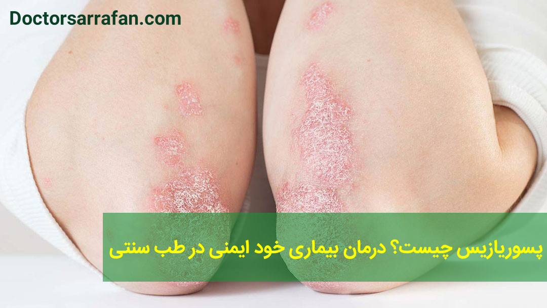 درمان پسوریازیس با طب سنتی`