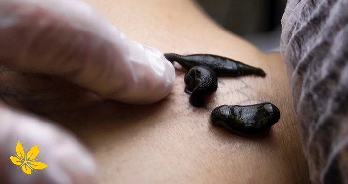 زالو برای درمان دیسک کمر - Leech for lumbar disc pain