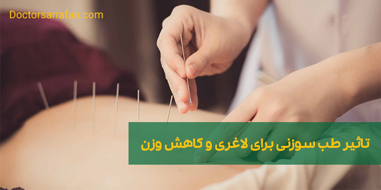 طب سوزنی برای لاغری | Acupuncture for weight loss