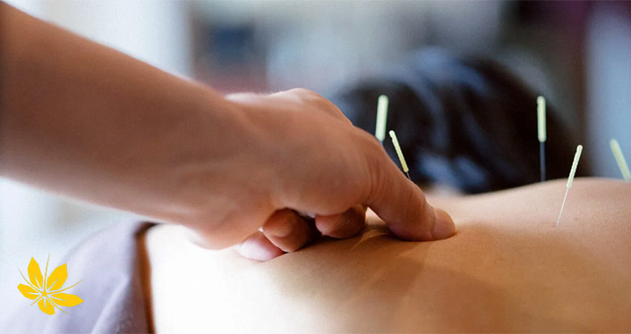 نقاط حساس برای طب سوزنی برای لاغری | Sensitive point for Acupuncture for weight loss