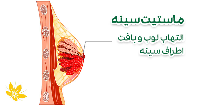 درد پستان و ماستیت سینه | Breast mastitis and pain