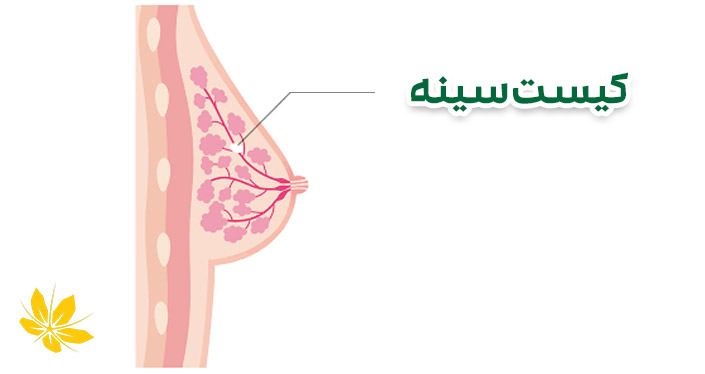 کیست سینه | breast cyst