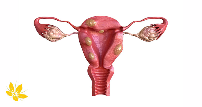 The cause of uterine fibroids | علت به وجود آمدن فیبروم رحم