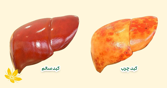 کبد سالم و کبد چرب - Fatty liver and healthy liver