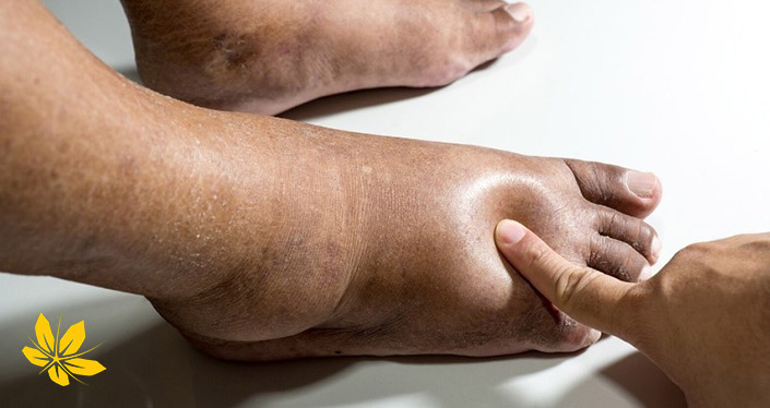 نارسایی کلیه و ورم پا - Kidney failure and leg swelling