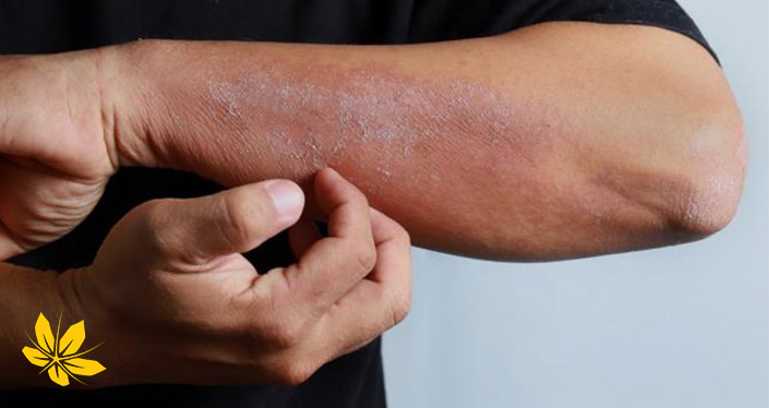 نارسایی کلیه و خارش پوست - Kidney failure and skin itching