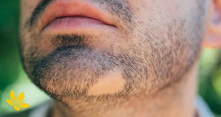 ریزش مو سکه‌ای - Coin hair loss