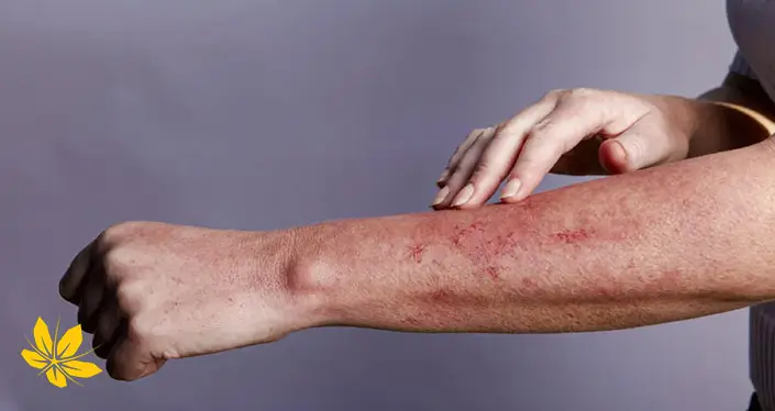 بثورات پوستی ایدز - HIV rash