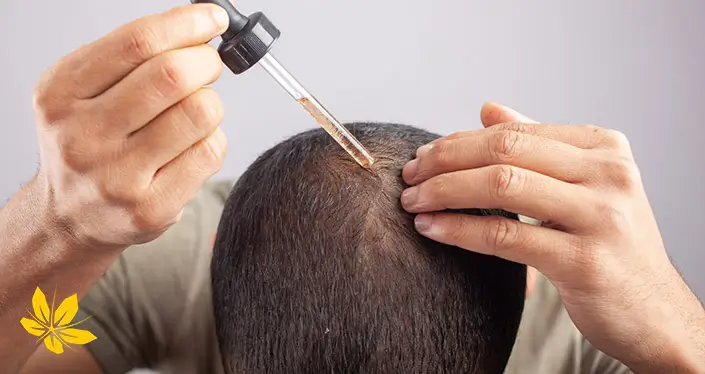 ماینوکسیدیل برای درمان ریزش مو - Minoxidil for hair loss treatment