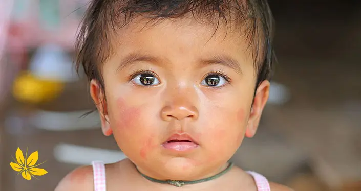 بثورات کودکان - kids rash