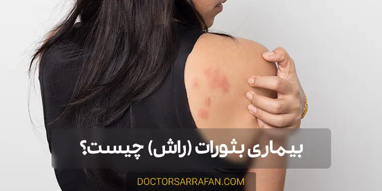 بیماری بثورات یا راش چیست؟ - What is rash disease