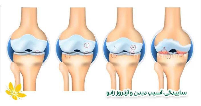 علائم و علتهای آرتروز زانو - Cause of knee arthritis