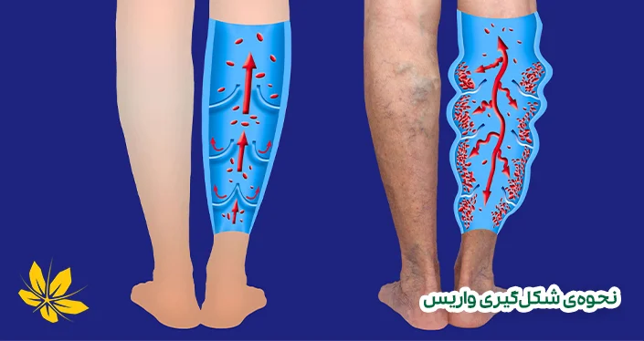 علت واریس و شکل‌گیری آن - Varicose causes