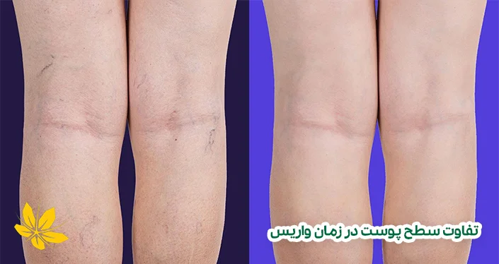 نشانه‌ها و علائم بیماری واریس - Varicose disease signs