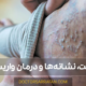 درمان واریس و اطلاعات آن - Varicose treatment and information