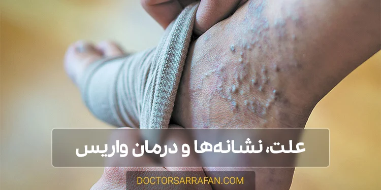 درمان واریس و اطلاعات آن - Varicose treatment and information