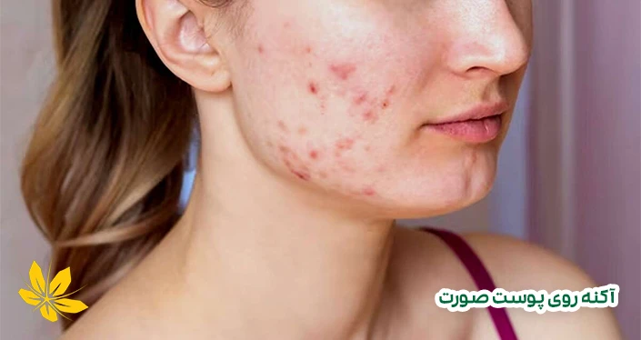 آکنه روی پوست - Acne on the face