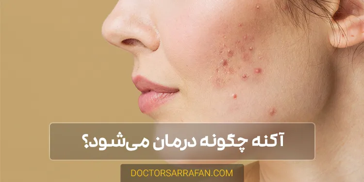 معرفی و درمان آکنه - acne introduction and treatment