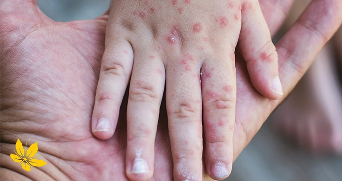 دلایل و علت بیماری سرخک - Measles disease causes