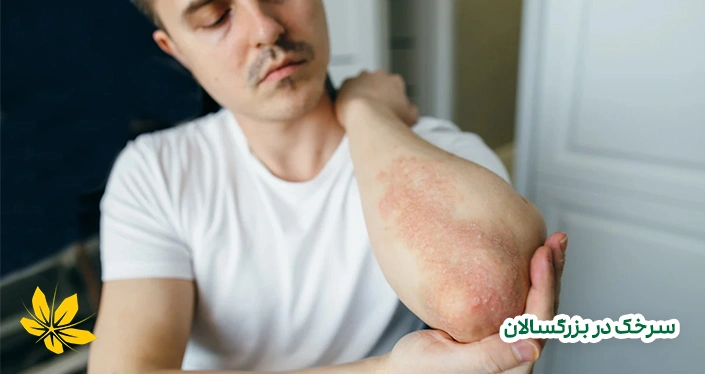 سرخک در بزرگسالان - Measles in adults