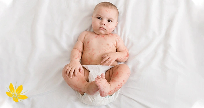 درمان سرخک - Measles treatment