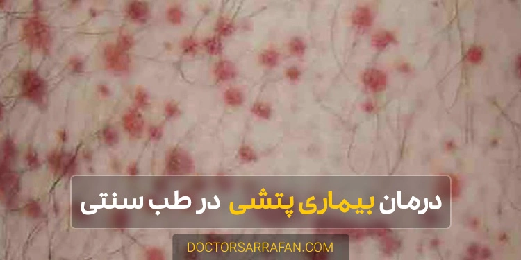 Treatment of petechiae - درمان بیماری پتشی