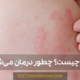 کهیر چیست؟ What-is-hives؟
