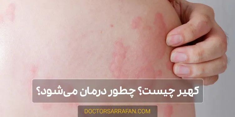 کهیر چیست؟ What-is-hives؟