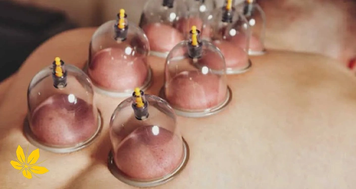 cupping - حجامت