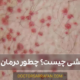 علت پتشی و راه درمان آن-petechiae-disease